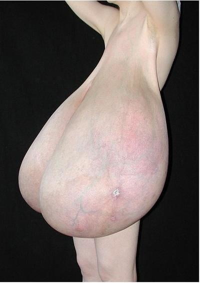 Macromastia Breast Hypertrophy Play Beautiful Milf Nude Selfie Min