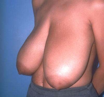 Sex Big Natural And Saggy Tits Pre-OP Pictures image