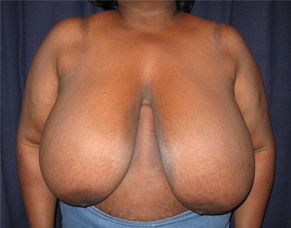 Sex Saggy Breast Reduction Coco Tits Image 311858949