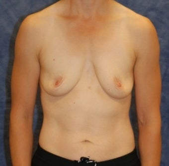 Saggy breast 45-54 - 104 Pics 