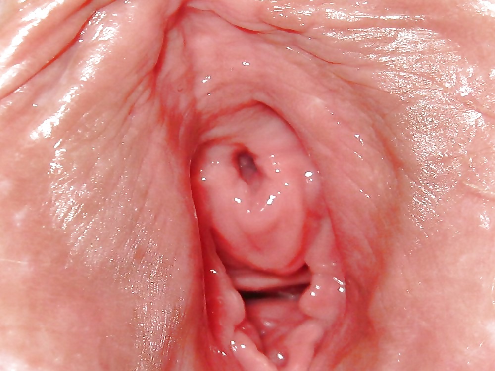 Vaginal Polyps.